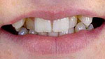 philadelphia porcelain veneers image