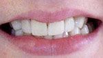 philadelphia porcelain veneers image