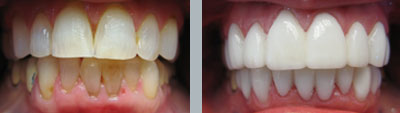 Lumineers Porcelain Veneers