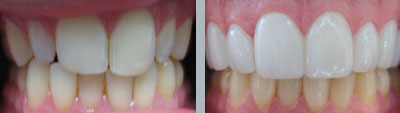 Porcelain Veneers