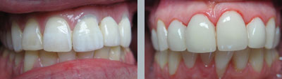 Lumineers Porcelain Veneers