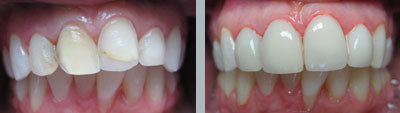 Lumineers Porcelain Veneers