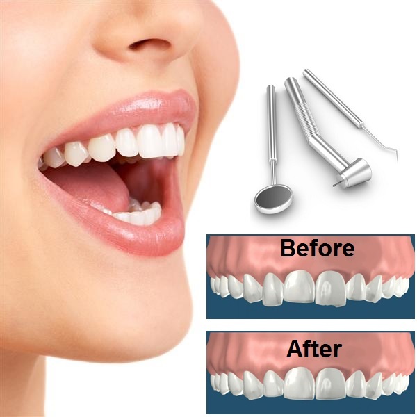 3 Cosmetic Procedures to Repair Tooth Grinding Damage