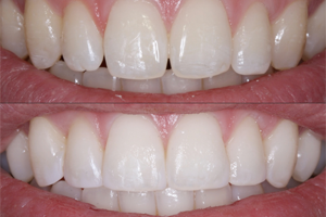 Altering the Look of Your Smile Through Bonding - Philadelphia Dentistry