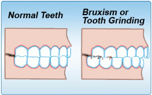 Bruxism-1-300x188