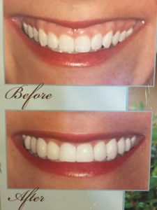 gummy smile before and after