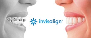 invisalign2345