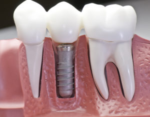 dental-implants-mexico