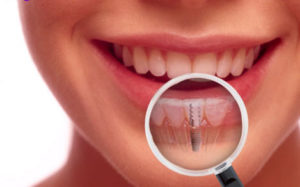 dental implants1