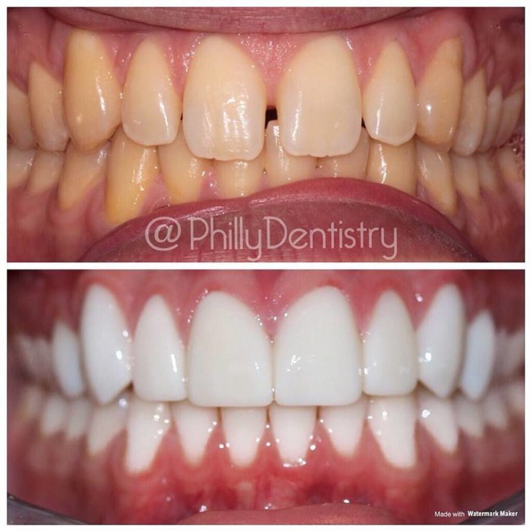 Veneers Special Philadelphia Dentistry